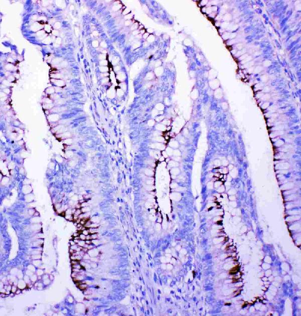 IHC analysis of PFN2 using anti-PFN2 antibody (PA2162). PFN2 was detected in paraffin-embedded section of human intestinal cancer tissues. Heat mediated antigen retrieval was performed in citrate buffer (pH6, epitope retrieval solution) for 20 mins. The tissue section was blocked with 10% goat serum. The tissue section was then incubated with 1μg/ml rabbit anti-PFN2 Antibody (PA2162) overnight at 4°C. Biotinylated goat anti-rabbit IgG was used as secondary antibody and incubated for 30 minutes at 37°C. The tissue section was developed using Strepavidin-Biotin-Complex (SABC)(Catalog # SA1022) with DAB as the chromogen.