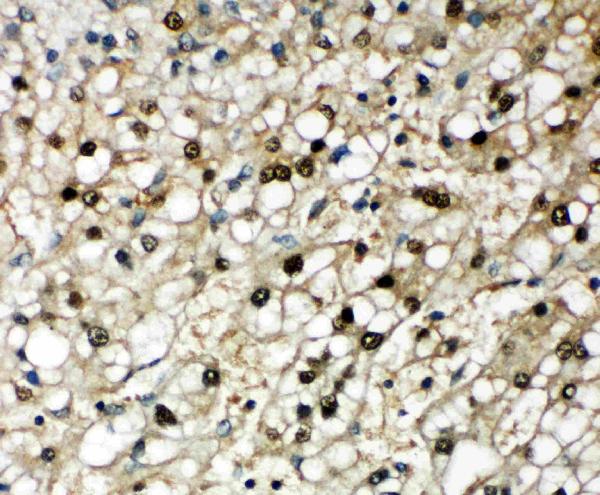 Anti-SBP/SELENBP1 antibody, PA2216, IHC(P) IHC(P): Human Liver Cancer Tissue