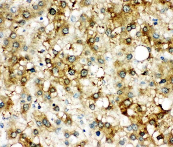 Anti-AACT/SERPINA3 antibody, PA2217, IHC(P) IHC(P): Human Liver Cancer Tissue