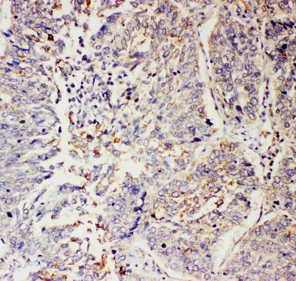 IHC analysis of SLC9A2 using anti-SLC9A2 antibody (PA2219). SLC9A2 was detected in paraffin-embedded section of human lung cancer tissues. Heat mediated antigen retrieval was performed in citrate buffer (pH6, epitope retrieval solution) for 20 mins. The tissue section was blocked with 10% goat serum. The tissue section was then incubated with 1μg/ml rabbit anti-SLC9A2 Antibody (PA2219) overnight at 4°C. Biotinylated goat anti-rabbit IgG was used as secondary antibody and incubated for 30 minutes at 37°C. The tissue section was developed using Strepavidin-Biotin-Complex (SABC)(Catalog # SA1022) with DAB as the chromogen.