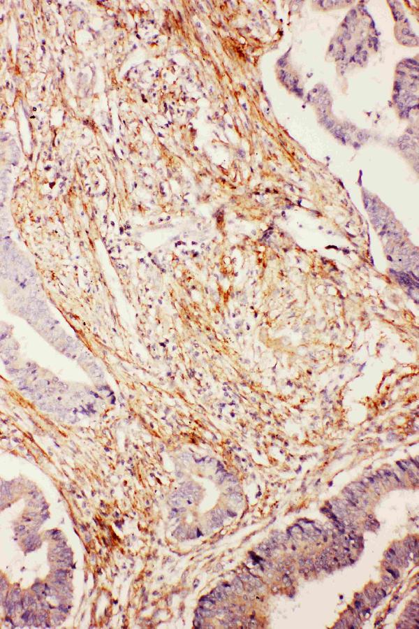 Anti-Diubiquitin antibody, PA2222, IHC(P) IHC(P): Human Intestinal Cancer Tissue