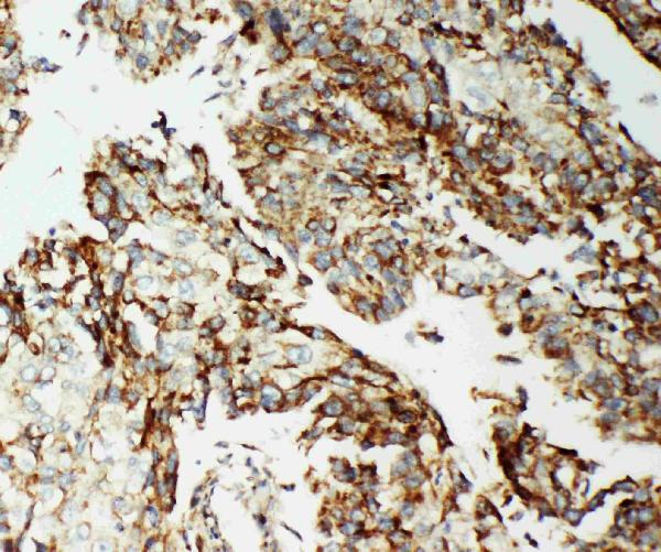 Anti-AIF antibody, PA2232, IHC(P) IHC(P): Human Lung Cancer Tissue