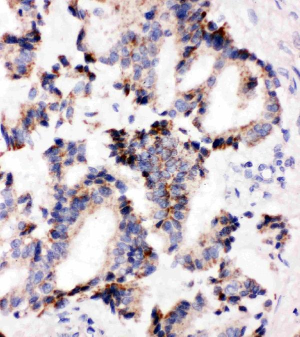 Anti-IRAK2 antibody, PA2236, IHC(P) IHC(P): Human Lung Cancer Tissue