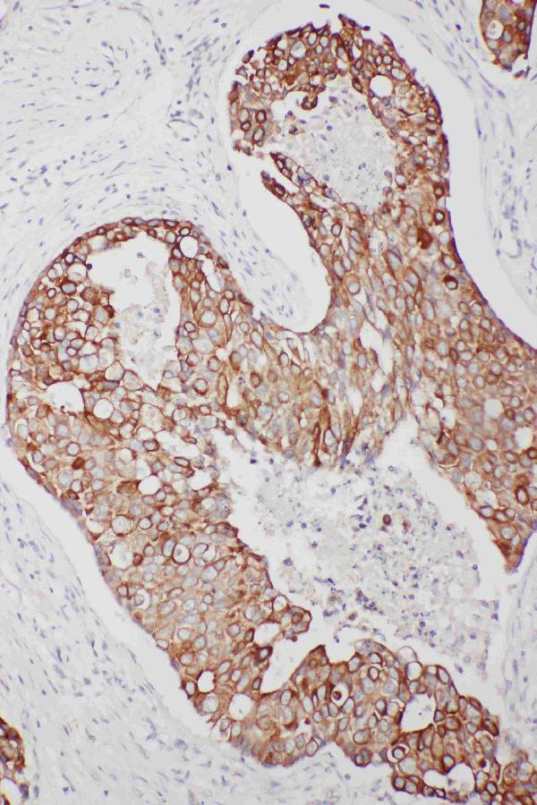 Anti-TNFAIP8L3 antibody, PA2257, IHC(P) IHC(P): Human Mammary Cancer Tissue