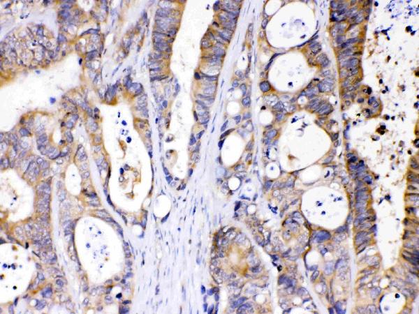 IHC analysis of Abhd5 using anti-Abhd5 antibody (PB10021). Abhd5 was detected in paraffin-embedded section of human intestinal cancer tissues. Heat mediated antigen retrieval was performed in citrate buffer (pH6, epitope retrieval solution) for 20 mins. The tissue section was blocked with 10% goat serum. The tissue section was then incubated with 1μg/ml rabbit anti-Abhd5 Antibody (PB10021) overnight at 4°C. Biotinylated goat anti-rabbit IgG was used as secondary antibody and incubated for 30 minutes at 37°C. The tissue section was developed using Strepavidin-Biotin-Complex (SABC)(Catalog # SA1022) with DAB as the chromogen.