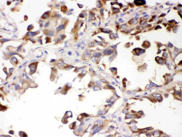 IHC analysis of ALDH7A1 using anti-ALDH7A1 antibody (PB10038). ALDH7A1 was detected in paraffin-embedded section of human lung cancer tissues. Heat mediated antigen retrieval was performed in citrate buffer (pH6, epitope retrieval solution) for 20 mins. The tissue section was blocked with 10% goat serum. The tissue section was then incubated with 1μg/ml rabbit anti-ALDH7A1 Antibody (PB10038) overnight at 4°C. Biotinylated goat anti-rabbit IgG was used as secondary antibody and incubated for 30 minutes at 37°C. The tissue section was developed using Strepavidin-Biotin-Complex (SABC)(Catalog # SA1022) with DAB as the chromogen.