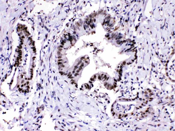 IHC analysis of PSMA3 using anti-PSMA3 antibody (PB10089). PSMA3 was detected in paraffin-embedded section of human intestinal cancer tissues. Heat mediated antigen retrieval was performed in citrate buffer (pH6, epitope retrieval solution) for 20 mins. The tissue section was blocked with 10% goat serum. The tissue section was then incubated with 1μg/ml rabbit anti-PSMA3 Antibody (PB10089) overnight at 4°C. Biotinylated goat anti-rabbit IgG was used as secondary antibody and incubated for 30 minutes at 37°C. The tissue section was developed using Strepavidin-Biotin-Complex (SABC)(Catalog # SA1022) with DAB as the chromogen.