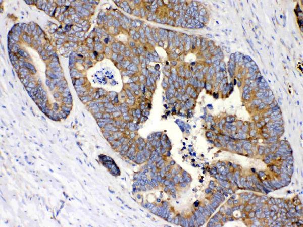 IHC analysis of MPS1 using anti-MPS1 antibody (PB10093). MPS1 was detected in paraffin-embedded section of human intestinal cancer tissues. Heat mediated antigen retrieval was performed in citrate buffer (pH6, epitope retrieval solution) for 20 mins. The tissue section was blocked with 10% goat serum. The tissue section was then incubated with 1μg/ml rabbit anti-MPS1 Antibody (PB10093) overnight at 4°C. Biotinylated goat anti-rabbit IgG was used as secondary antibody and incubated for 30 minutes at 37°C. The tissue section was developed using Strepavidin-Biotin-Complex (SABC)(Catalog # SA1022) with DAB as the chromogen.