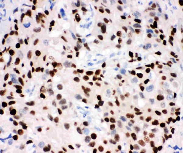 IHC analysis of Progesterone Receptor using anti-Progesterone Receptor antibody (PB9009). Progesterone Receptor was detected in paraffin-embedded section of human mammary cancer tissues. Heat mediated antigen retrieval was performed in citrate buffer (pH6, epitope retrieval solution) for 20 mins. The tissue section was blocked with 10% goat serum. The tissue section was then incubated with 1μg/ml rabbit anti-Progesterone Receptor Antibody (PB9009) overnight at 4°C. Biotinylated goat anti-rabbit IgG was used as secondary antibody and incubated for 30 minutes at 37°C. The tissue section was developed using Strepavidin-Biotin-Complex (SABC)(Catalog # SA1022) with DAB as the chromogen.