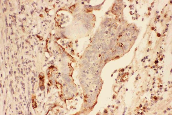 IHC analysis of MMP7 using anti-MMP7 antibody (PB9037).