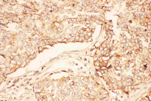 IHC analysis of AKT2 using anti-AKT2 antibody (PB9043). AKT2 was detected in paraffin-embedded section of human lung cancer tissues. Heat mediated antigen retrieval was performed in citrate buffer (pH6, epitope retrieval solution) for 20 mins. The tissue section was blocked with 10% goat serum. The tissue section was then incubated with 1μg/ml rabbit anti-AKT2 Antibody (PB9043) overnight at 4°C. Biotinylated goat anti-rabbit IgG was used as secondary antibody and incubated for 30 minutes at 37°C. The tissue section was developed using Strepavidin-Biotin-Complex (SABC)(Catalog # SA1022) with DAB as the chromogen.