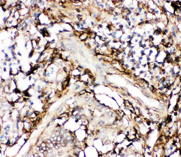 IHC analysis of Annexin V using anti-Annexin V antibody (PB9044). Annexin V was detected in paraffin-embedded section of Human Intestinal Cancer Tissue. Heat mediated antigen retrieval was performed in citrate buffer (pH6, epitope retrieval solution) for 20 mins. The tissue section was blocked with 10% goat serum. The tissue section was then incubated with 1μg/ml rabbit anti-Annexin V Antibody (PB9044) overnight at 4°C. Biotinylated goat anti-rabbit IgG was used as secondary antibody and incubated for 30 minutes at 37°C. The tissue section was developed using Strepavidin-Biotin-Complex (SABC)(Catalog # SA1022) with DAB as the chromogen.