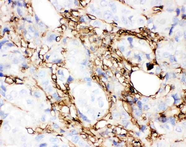 IHC analysis of Annexin V using anti-Annexin V antibody (PB9044). Annexin V was detected in paraffin-embedded section of Human Mammary Cancer Tissue. Heat mediated antigen retrieval was performed in citrate buffer (pH6, epitope retrieval solution) for 20 mins. The tissue section was blocked with 10% goat serum. The tissue section was then incubated with 1μg/ml rabbit anti-Annexin V Antibody (PB9044) overnight at 4°C. Biotinylated goat anti-rabbit IgG was used as secondary antibody and incubated for 30 minutes at 37°C. The tissue section was developed using Strepavidin-Biotin-Complex (SABC)(Catalog # SA1022) with DAB as the chromogen.