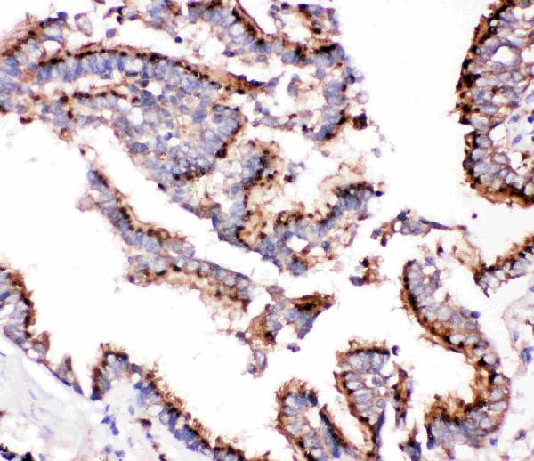 IHC analysis of Cathepsin D using anti-Cathepsin D antibody (PB9047).