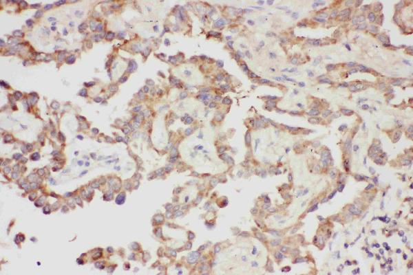 IHC analysis of Galectin-3 using anti-Galectin-3 antibody (PB9081). Galectin-3 was detected in paraffin-embedded section of Human Lung Cancer Tissue. Heat mediated antigen retrieval was performed in citrate buffer (pH6, epitope retrieval solution) for 20 mins. The tissue section was blocked with 10% goat serum. The tissue section was then incubated with 1μg/ml rabbit anti-Galectin-3 Antibody (PB9081) overnight at 4°C. Biotinylated goat anti-rabbit IgG was used as secondary antibody and incubated for 30 minutes at 37°C. The tissue section was developed using Strepavidin-Biotin-Complex (SABC)(Catalog # SA1022) with DAB as the chromogen.