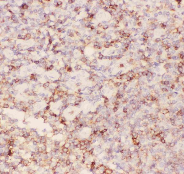 IHC analysis of CD43 using anti-CD43 antibody (PB9095). CD43 was detected in paraffin-embedded section of human tonsil tissues. Heat mediated antigen retrieval was performed in citrate buffer (pH6, epitope retrieval solution) for 20 mins. The tissue section was blocked with 10% goat serum. The tissue section was then incubated with 1μg/ml rabbit anti-CD43 Antibody (PB9095) overnight at 4°C. Biotinylated goat anti-rabbit IgG was used as secondary antibody and incubated for 30 minutes at 37°C. The tissue section was developed using Strepavidin-Biotin-Complex (SABC)(Catalog # SA1022) with DAB as the chromogen.