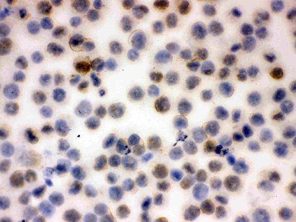 IHC analysis of CD43 using anti-CD43 antibody (PB9095). CD43 was detected in immunocytochemical section of K562 Cell. Enzyme antigen retrieval was performed using IHC enzyme antigen retrieval reagent (AR0022) for 15 mins. The cells were blocked with 10% goat serum. And then incubated with 1μg/ml rabbit anti-CD43 Antibody (PB9095) overnight at 4°C. Biotinylated goat anti-rabbit IgG was used as secondary antibody and incubated for 30 minutes at 37°C. The section was developed using Strepavidin-Biotin-Complex (SABC)(Catalog # SA1022) with DAB as the chromogen.