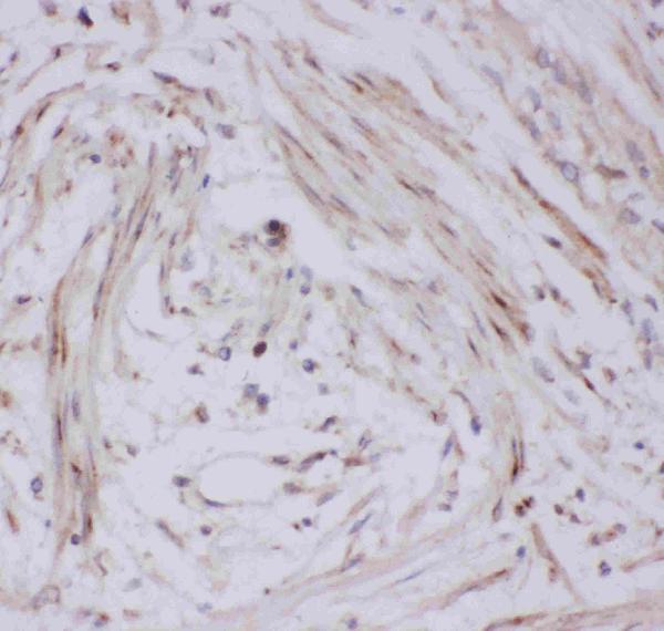 IHC analysis of GLUT4 using anti-GLUT4 antibody (PB9109). GLUT4 was detected in paraffin-embedded section of human intestinal cancer tissues. Heat mediated antigen retrieval was performed in citrate buffer (pH6, epitope retrieval solution) for 20 mins. The tissue section was blocked with 10% goat serum. The tissue section was then incubated with 1μg/ml rabbit anti-GLUT4 Antibody (PB9109) overnight at 4°C. Biotinylated goat anti-rabbit IgG was used as secondary antibody and incubated for 30 minutes at 37°C. The tissue section was developed using Strepavidin-Biotin-Complex (SABC)(Catalog # SA1022) with DAB as the chromogen.