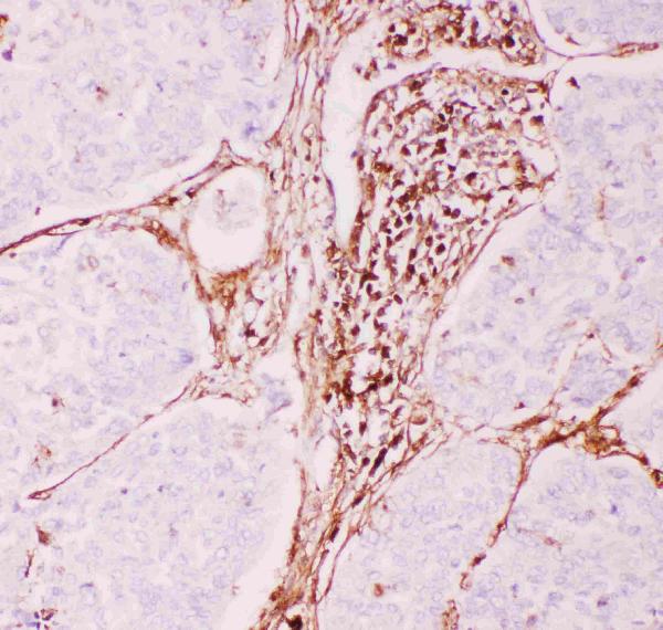 Anti-P Glycoprotein Picoband antibody, RP1034-3.JPG IHC(P): Human Lung Cancer Tissue