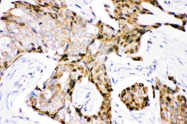 IHC analysis of Ubiquitin using anti-Ubiquitin antibody (PB9122). Ubiquitin was detected in paraffin-embedded section of human mammary cancer tissue. Heat mediated antigen retrieval was performed in citrate buffer (pH6, epitope retrieval solution) for 20 mins. The tissue section was blocked with 10% goat serum. The tissue section was then incubated with 1μg/ml rabbit anti-Ubiquitin Antibody (PB9122) overnight at 4°C. Biotinylated goat anti-rabbit IgG was used as secondary antibody and incubated for 30 minutes at 37°C. The tissue section was developed using Strepavidin-Biotin-Complex (SABC)(Catalog # SA1022) with DAB as the chromogen.