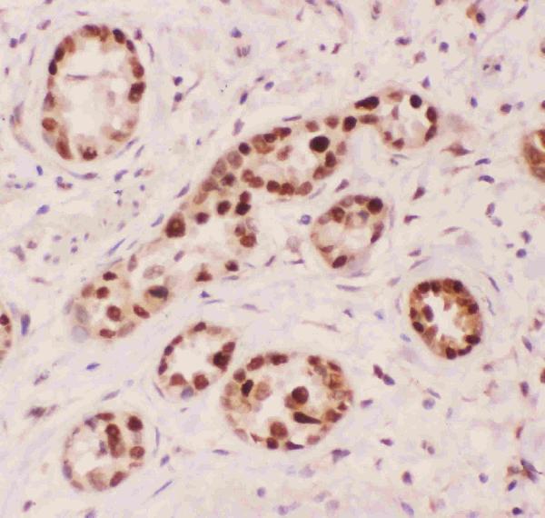 IHC analysis of APEX1 using anti-APEX1 antibody (PB9128). APEX1 was detected in paraffin-embedded section of human lung cancer tissue. Heat mediated antigen retrieval was performed in citrate buffer (pH6, epitope retrieval solution) for 20 mins. The tissue section was blocked with 10% goat serum. The tissue section was then incubated with 1μg/ml rabbit anti-APEX1 Antibody (PB9128) overnight at 4°C. Biotinylated goat anti-rabbit IgG was used as secondary antibody and incubated for 30 minutes at 37°C. The tissue section was developed using Strepavidin-Biotin-Complex (SABC)(Catalog # SA1022) with DAB as the chromogen.