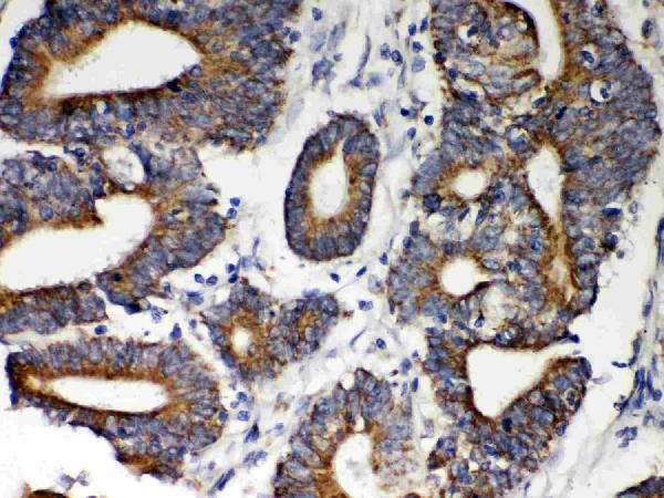 Anti-Hsp60 Picoband antibody, PB9337, IHC(P) IHC(P): Human Intestinal Cancer Tissue