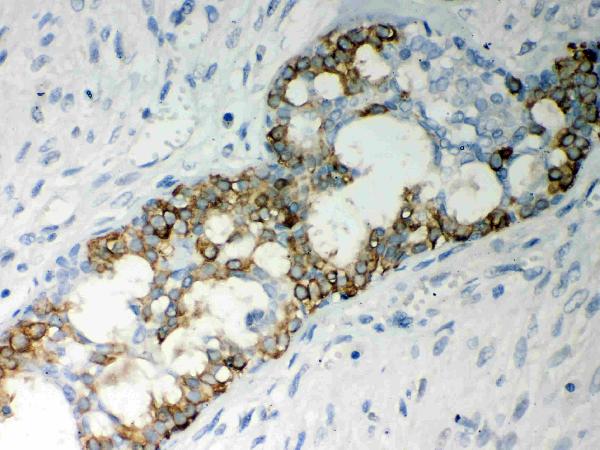 Anti-Caspase-7 Picoband antibody, PB9369,IHC(P) IHC(P): Human Mammary Cancer Tissue