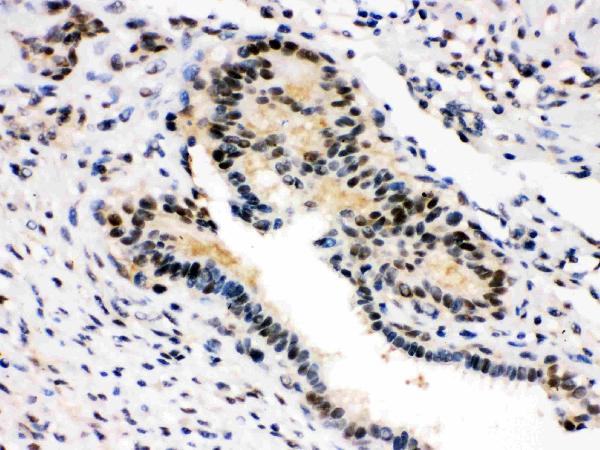 Anti-SMN1/2 Picoband antibody, PB9398,IHC(P) IHC(P): Human Mammary Cancer Tissue
