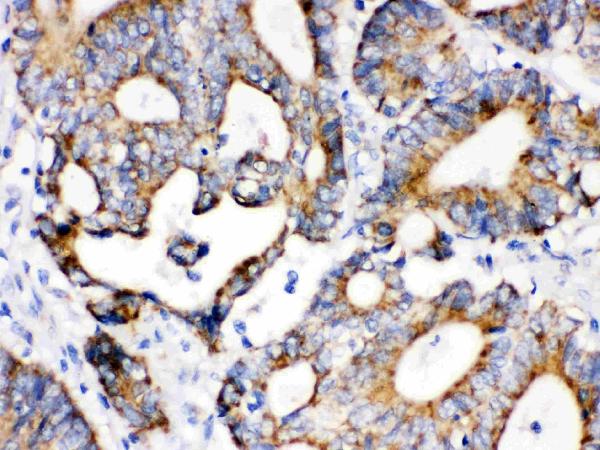 IHC analysis of IDH2 using anti-IDH2 antibody (PB9602).