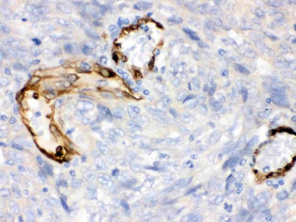 IHC analysis of IDO1 using anti-IDO1 antibody (PB9603). IDO1 was detected in paraffin-embedded section of Human Lung Cancer Tissue. Heat mediated antigen retrieval was performed in citrate buffer (pH6, epitope retrieval solution) for 20 mins. The tissue section was blocked with 10% goat serum. The tissue section was then incubated with 1μg/ml rabbit anti-IDO1 Antibody (PB9603) overnight at 4°C. Biotinylated goat anti-rabbit IgG was used as secondary antibody and incubated for 30 minutes at 37°C. The tissue section was developed using Strepavidin-Biotin-Complex (SABC)(Catalog # SA1022) with DAB as the chromogen.