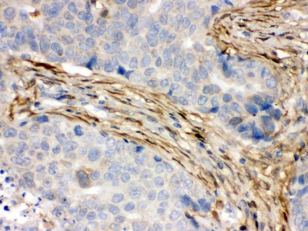 IHC analysis of S100A6 using anti-S100A6 antibody (PB9676). S100A6 was detected in paraffin-embedded section of Human Mammary Cancer tissues. Heat mediated antigen retrieval was performed in citrate buffer (pH6, epitope retrieval solution) for 20 mins. The tissue section was blocked with 10% goat serum. The tissue section was then incubated with 1μg/ml rabbit anti-S100A6 Antibody (PB9676) overnight at 4°C. Biotinylated goat anti-rabbit IgG was used as secondary antibody and incubated for 30 minutes at 37°C. The tissue section was developed using Strepavidin-Biotin-Complex (SABC)(Catalog # SA1022) with DAB as the chromogen.