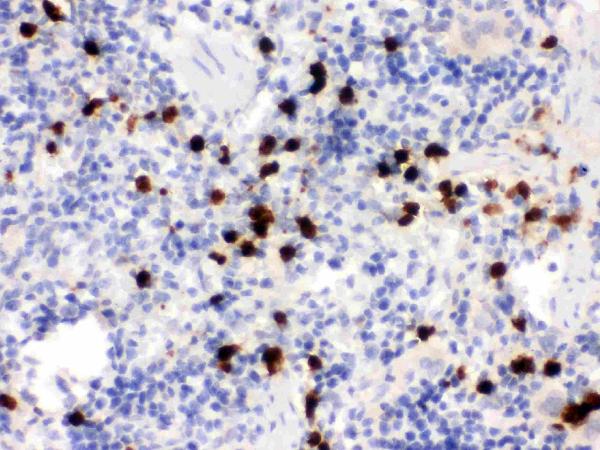 IHC analysis of S100A9 using anti-S100A9 antibody (PB9678).