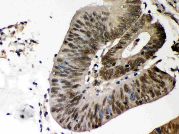 IHC analysis of CSNK1A1 using anti-CSNK1A1 antibody (PB9693). CSNK1A1 was detected in paraffin-embedded section of human intestinal cancer tissues. Heat mediated antigen retrieval was performed in citrate buffer (pH6, epitope retrieval solution) for 20 mins. The tissue section was blocked with 10% goat serum. The tissue section was then incubated with 1μg/ml rabbit anti-CSNK1A1 Antibody (PB9693) overnight at 4°C. Biotinylated goat anti-rabbit IgG was used as secondary antibody and incubated for 30 minutes at 37°C. The tissue section was developed using Strepavidin-Biotin-Complex (SABC)(Catalog # SA1022) with DAB as the chromogen.