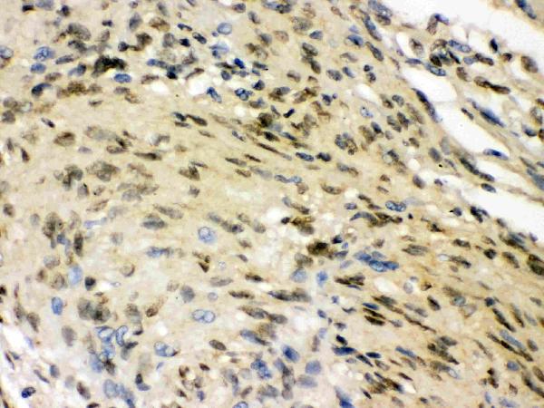 IHC analysis of ELAVL4 using anti-ELAVL4 antibody (PB9698). ELAVL4 was detected in paraffin-embedded section of human meningeoma tissues. Heat mediated antigen retrieval was performed in citrate buffer (pH6, epitope retrieval solution) for 20 mins. The tissue section was blocked with 10% goat serum. The tissue section was then incubated with 1μg/ml rabbit anti-ELAVL4 Antibody (PB9698) overnight at 4°C. Biotinylated goat anti-rabbit IgG was used as secondary antibody and incubated for 30 minutes at 37°C. The tissue section was developed using Strepavidin-Biotin-Complex (SABC)(Catalog # SA1022) with DAB as the chromogen.