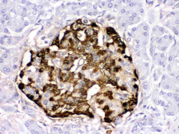 IHC analysis of GLP1 using anti-GLP1 antibody (PB9705). GLP1 was detected in paraffin-embedded section of human pancreatic cancer tissues. Heat mediated antigen retrieval was performed in citrate buffer (pH6, epitope retrieval solution) for 20 mins. The tissue section was blocked with 10% goat serum. The tissue section was then incubated with 1μg/ml rabbit anti-GLP1 Antibody (PB9705) overnight at 4°C. Biotinylated goat anti-rabbit IgG was used as secondary antibody and incubated for 30 minutes at 37°C. The tissue section was developed using Strepavidin-Biotin-Complex (SABC)(Catalog # SA1022) with DAB as the chromogen.