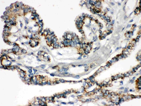 IHC analysis of Bik using anti-Bik antibody (PB9755). Bik was detected in paraffin-embedded section of Human Thyroid Cancer Tissue. Heat mediated antigen retrieval was performed in citrate buffer (pH6, epitope retrieval solution) for 20 mins. The tissue section was blocked with 10% goat serum. The tissue section was then incubated with 1μg/ml rabbit anti-Bik Antibody (PB9755) overnight at 4°C. Biotinylated goat anti-rabbit IgG was used as secondary antibody and incubated for 30 minutes at 37°C. The tissue section was developed using Strepavidin-Biotin-Complex (SABC)(Catalog # SA1022) with DAB as the chromogen.