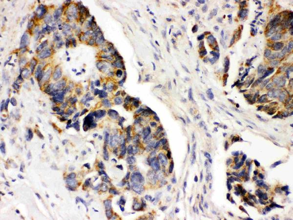 IHC analysis of PDGFRA using anti-PDGFRA antibody (PB9771). PDGFRA was detected in paraffin-embedded section of Human Intestinal Cancer Tissue. Heat mediated antigen retrieval was performed in citrate buffer (pH6, epitope retrieval solution) for 20 mins. The tissue section was blocked with 10% goat serum. The tissue section was then incubated with 1μg/ml rabbit anti-PDGFRA Antibody (PB9771) overnight at 4°C. Biotinylated goat anti-rabbit IgG was used as secondary antibody and incubated for 30 minutes at 37°C. The tissue section was developed using Strepavidin-Biotin-Complex (SABC)(Catalog # SA1022) with DAB as the chromogen.