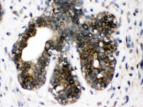 IHC analysis of CCT4 using anti-CCT4 antibody (PB9927). CCT4 was detected in paraffin-embedded section of human mammary cancer tissues. Heat mediated antigen retrieval was performed in citrate buffer (pH6, epitope retrieval solution) for 20 mins. The tissue section was blocked with 10% goat serum. The tissue section was then incubated with 1μg/ml rabbit anti-CCT4 Antibody (PB9927) overnight at 4°C. Biotinylated goat anti-rabbit IgG was used as secondary antibody and incubated for 30 minutes at 37°C. The tissue section was developed using Strepavidin-Biotin-Complex (SABC)(Catalog # SA1022) with DAB as the chromogen.