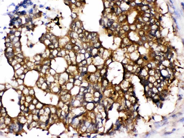 IHC analysis of CCT5 using anti-CCT5 antibody (PB9928). CCT5 was detected in paraffin-embedded section of human intestinal cancer tissues. Heat mediated antigen retrieval was performed in citrate buffer (pH6, epitope retrieval solution) for 20 mins. The tissue section was blocked with 10% goat serum. The tissue section was then incubated with 1μg/ml rabbit anti-CCT5 Antibody (PB9928) overnight at 4°C. Biotinylated goat anti-rabbit IgG was used as secondary antibody and incubated for 30 minutes at 37°C. The tissue section was developed using Strepavidin-Biotin-Complex (SABC)(Catalog # SA1022) with DAB as the chromogen.