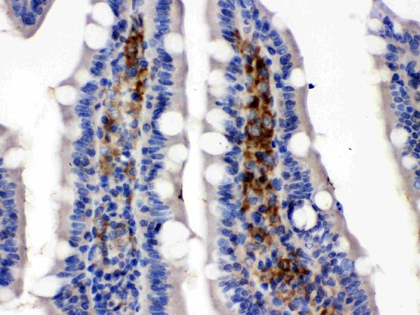 IHC analysis of SLC2A5 using anti-SLC2A5 antibody (PB9960). SLC2A5 was detected in paraffin-embedded section of rat intestinal cancer tissues. Heat mediated antigen retrieval was performed in citrate buffer (pH6, epitope retrieval solution) for 20 mins. The tissue section was blocked with 10% goat serum. The tissue section was then incubated with 1μg/ml rabbit anti-SLC2A5 Antibody (PB9960) overnight at 4°C. Biotinylated goat anti-rabbit IgG was used as secondary antibody and incubated for 30 minutes at 37°C. The tissue section was developed using Strepavidin-Biotin-Complex (SABC)(Catalog # SA1022) with DAB as the chromogen.