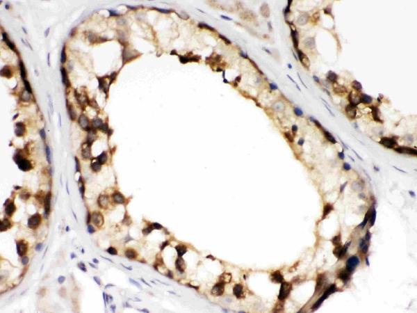 IHC analysis of CCT2 using anti-CCT2 antibody (PB9992). CCT2 was detected in paraffin-embedded section of human testis tissues. Heat mediated antigen retrieval was performed in citrate buffer (pH6, epitope retrieval solution) for 20 mins. The tissue section was blocked with 10% goat serum. The tissue section was then incubated with 1μg/ml rabbit anti-CCT2 Antibody (PB9992) overnight at 4°C. Biotinylated goat anti-rabbit IgG was used as secondary antibody and incubated for 30 minutes at 37°C. The tissue section was developed using Strepavidin-Biotin-Complex (SABC)(Catalog # SA1022) with DAB as the chromogen.