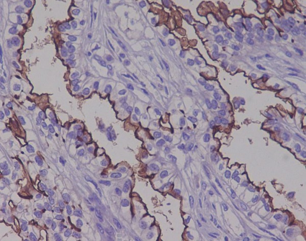 Immunohistochemical analysis of paraffin-embedded human ovarian cancer, using MUC1 Antibody.