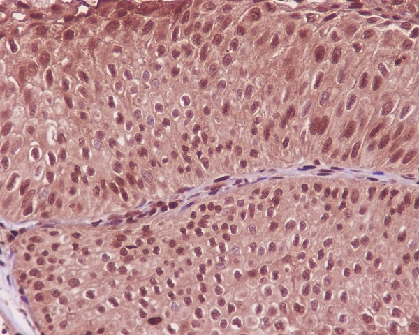 Immunohistochemical analysis of paraffin-embedded human bladder cancer, using GAPDH Antibody.