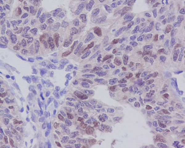 Immunohistochemical analysis of paraffin-embedded human ovary carcinoma, using E2F1 Antibody.