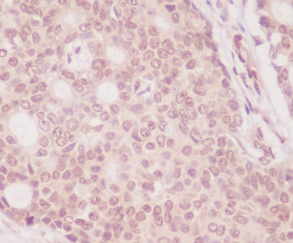 Immunohistochemical analysis of paraffin-embedded human breast carcinoma, using eIF4EBP1 Antibody.