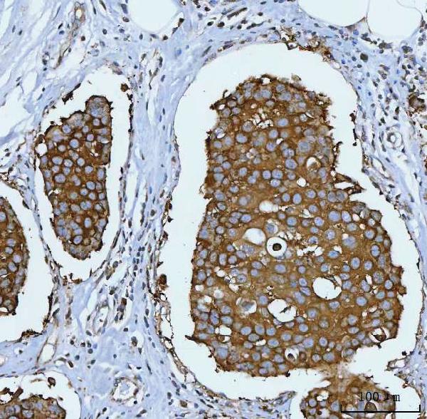 Immunohistochemical analysis of paraffin-embedded human brest cancer, using Hsp90 Antibody.