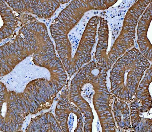 Immunohistochemical analysis of paraffin-embedded human colorectal adenocarcinoma, using Hsp90 Antibody.