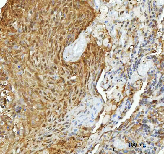 Immunohistochemical analysis of paraffin-embedded human lung cancer, using Hsp90 Antibody.