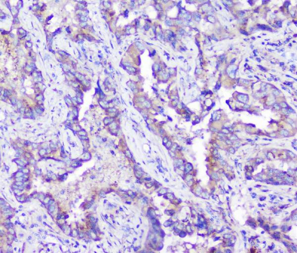 IHC analysis of ARSA using anti-ARSA antibody (M02583). ARSA was detected in paraffin-embedded section of human lung cancer tissue. Heat mediated antigen retrieval was performed in citrate buffer (pH6, epitope retrieval solution) for 20 mins. The tissue section was blocked with 10% goat serum. The tissue section was then incubated with 1μg/ml rabbit anti-ARSA Antibody (M02583) overnight at 4°C. Biotinylated goat anti-rabbit IgG was used as secondary antibody and incubated for 30 minutes at 37°C. The tissue section was developed using Strepavidin-Biotin-Complex (SABC)(Catalog # SA1022) with DAB as the chromogen.