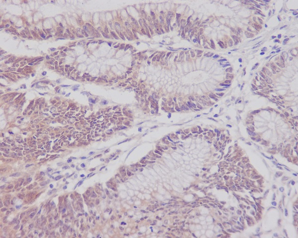 IHC analysis of CD3 epsilon using anti-CD3 epsilon antibody (M02675-2) on human colon cancer. CD3 epsilon was detected in paraffin-embedded section. Heat mediated antigen retrieval was performed in citrate buffer (pH6, epitope retrieval solution) for 20 mins. The tissue section was blocked with 10% goat serum. The tissue section was then incubated with 1ug/ml rabbit anti-CD3 epsilon Antibody (M02675-2) overnight at 4°C. Biotinylated goat anti Rabbit IgG IgG antibody was used as secondary antibody and incubated for 30 minutes at 37°C. The tissue section was developed using Strepavidin-Biotin-Complex (SABC)(Catalog # SA1022) with DAB as the chromogen.